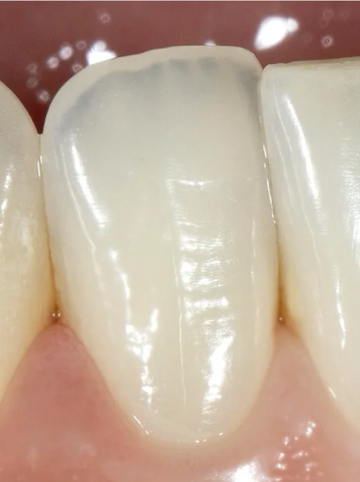 Restauração anterior com textura natural